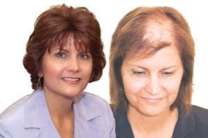 Hair loss treatment