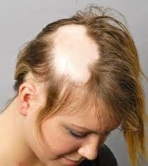 Woman hair loss