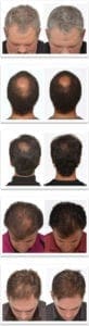 Before and after hair effect on women