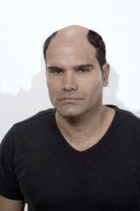Man with hair loss