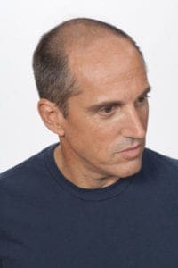 Man with hair loss