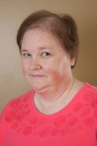 Hair loss of a woman